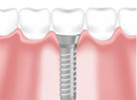 イラスト_インプラント